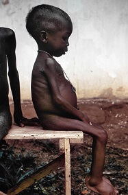 Niña enferma con kwashiorkor