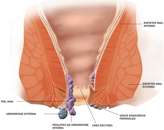Hemorroides