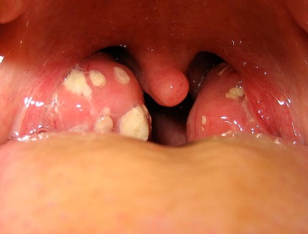Amigdalitis con placas producidas por bacterias