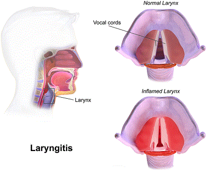 Laringitis